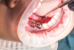 Преимущества и правила установки коронок на молочные зубы: что нужно знать 